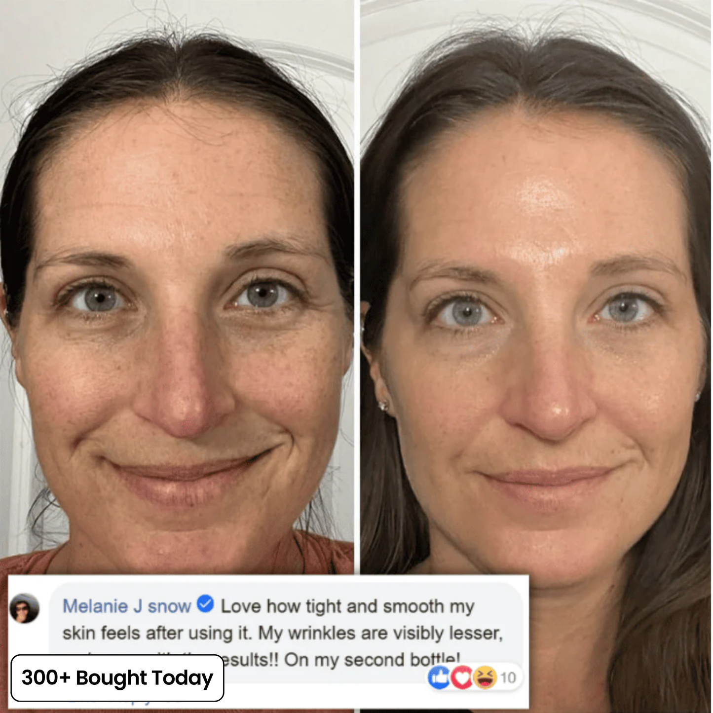 Serum Anti ride et cerne